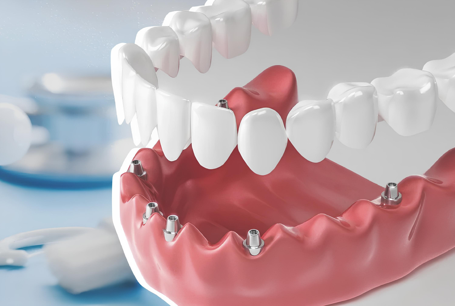 Имплантация зубов all on 6. Имплантация зубов all on 4. Имплантация зубов по технологии all-on-6 ("все на шести").. Имплантация зубов по технологии «all on 4» верхней. Несъемные зубные протезы.
